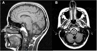 Characteristic Eye Movements in Ataxia-Telangiectasia-Like Disorder: An Explanatory Hypothesis